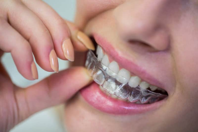 Uma mulher retirando o seu aparelho ortodôntico, um alinhador transparente do tipo invisalign