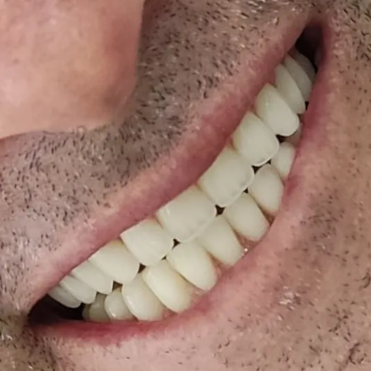 Implante Dentário 8 Homem de meia-idade sorrindo espontaneamente e feliz, mostrando o resultado natural de uma reabilitação oral completa com implantes dentários realizada pelo Prof. Dr. Rafael Muglia na Clínica Muglia em Vargem Grande Paulista.