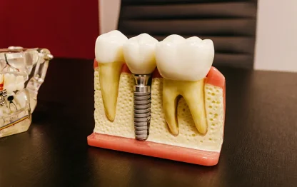 Implantes Dentários: Questões Frequentes e Respostas Diretas