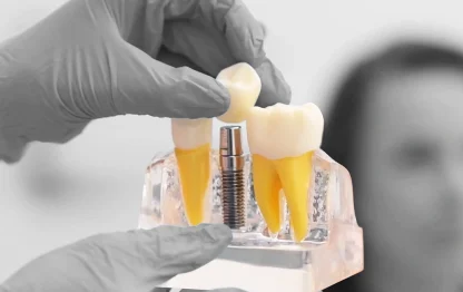Implantes Dentários em Carga Imediata: Tudo o Que Você Precisa Saber