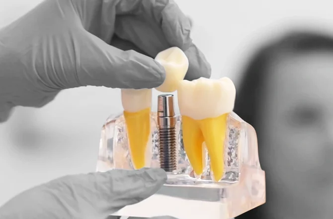Implantes Dentários em Carga Imediata: Tudo o Que Você Precisa Saber