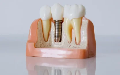O que são os implantes dentários?