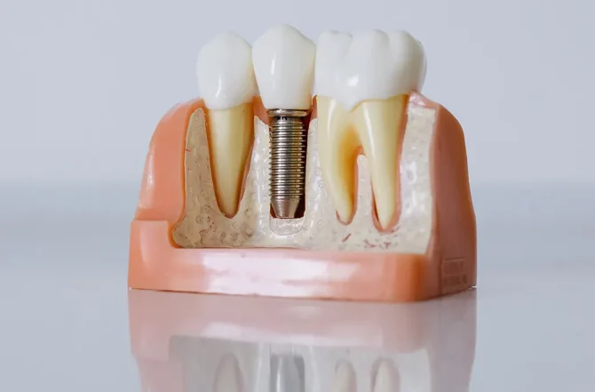 O que são os implantes dentários?
