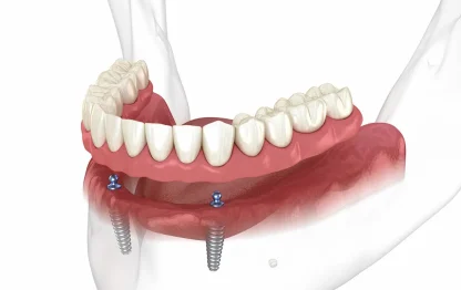 Prótese Overdenture: Uma Solução removível retida por implantes dentários