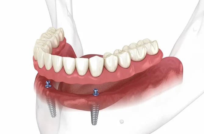 Prótese Overdenture: Uma Solução removível retida por implantes dentários