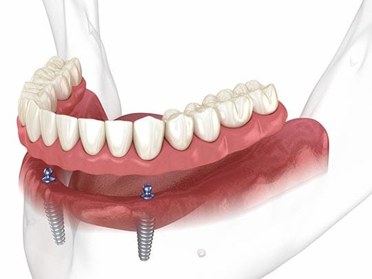Overdentures são próteses totais retidas por implantes dentários usadas para reabilitação de toda uma arcada desdentada. Tem diversas vantagens como facilidade na higienização, serem mais acessíveis do que as fixas dentre outras. São normalmente mais indicadas para as arcada inferior, (mandíbula). Como tudo esta modalidade de tratamento com implantes também tem suas desvantagens. Entenda a seguir as características deste tipo de solução.