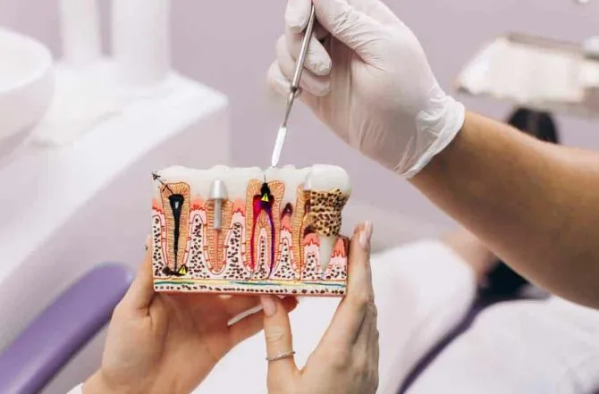 Tratamento de Canal (Endodontia)