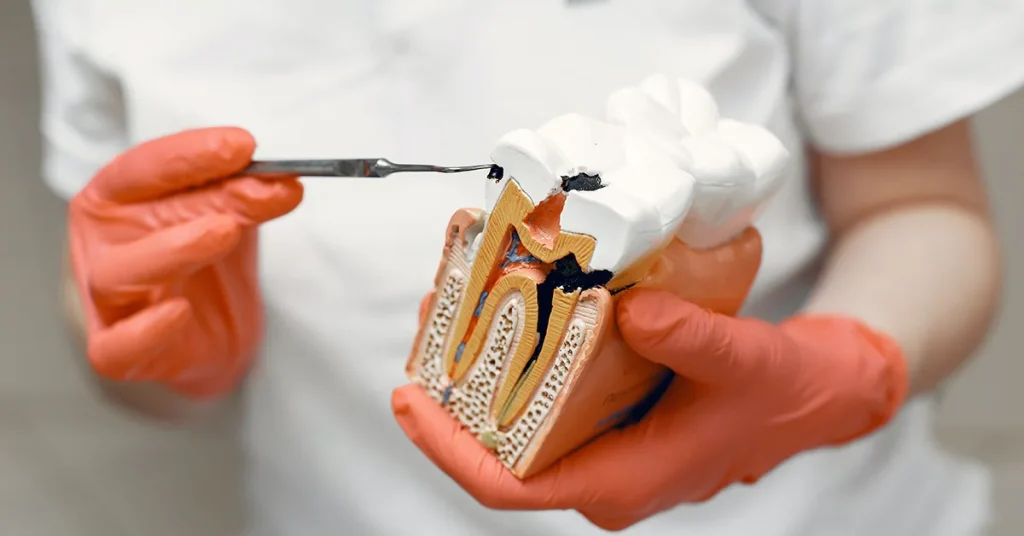 O dentista endodontista mostra o modelo de um dente onde uma lesão cariosa atingiu a polpa dentária, um caso onde normalmente se indica o tratamento de canal. Com um instrumental o dentista aponta uma cárie em estágio inicial, onde ainda poderia ser evitado o canal. Na parte superior do dente pode-se observar uma cárie profunda, quase chegando à polpa. Próximo ao dedão é que se observa a cárie que atingiu a polpa.
