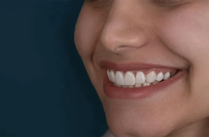 Facetas em resina: O expert Dr. Sergio Oliveira explica os detalhes sobre as facetas dentais em resina composta