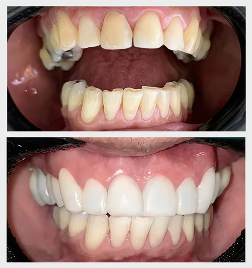 Facetas em resina: O expert Dr. Sergio Oliveira explica os detalhes sobre as facetas dentais em resina composta 1 Facetas Dentais em Resina antes e depois