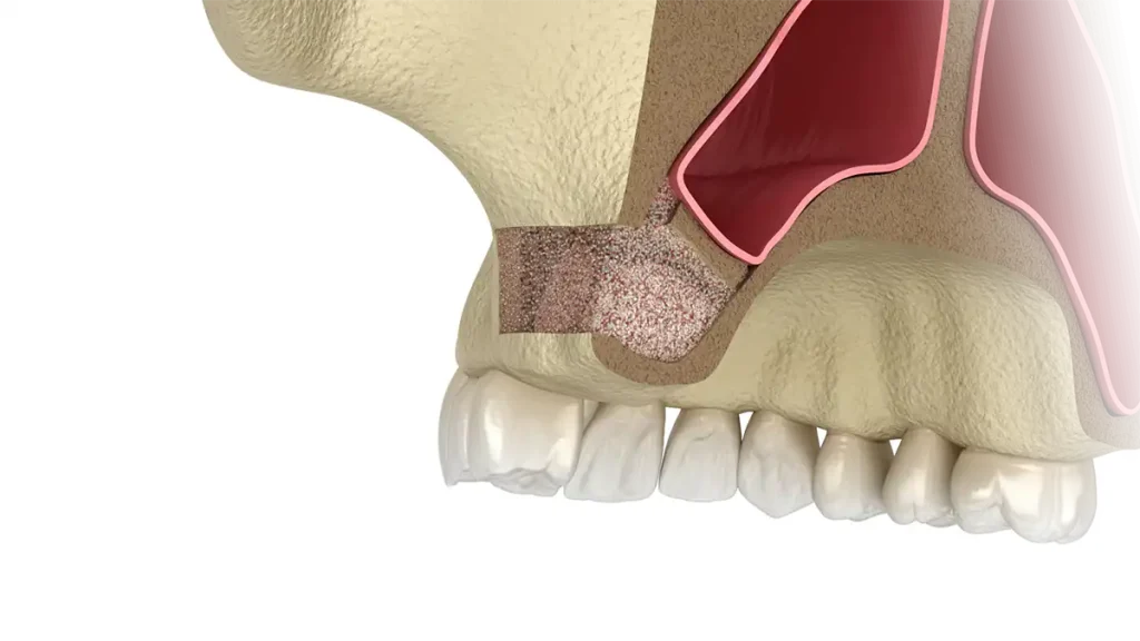 Preenchimento da área onde pretende-se implantes