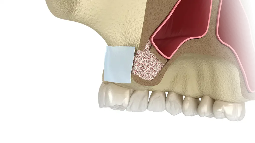 Proteção externa com membrana (podem ser usados diversos tipos reabsorvíveis)