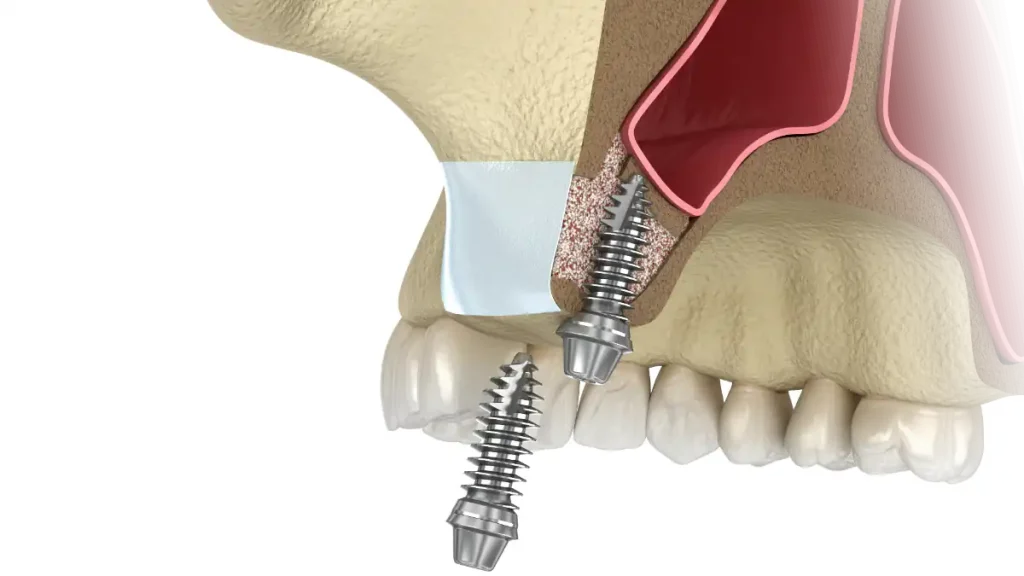 Instalação dos implantes junto do enxerto ou após 6 meses