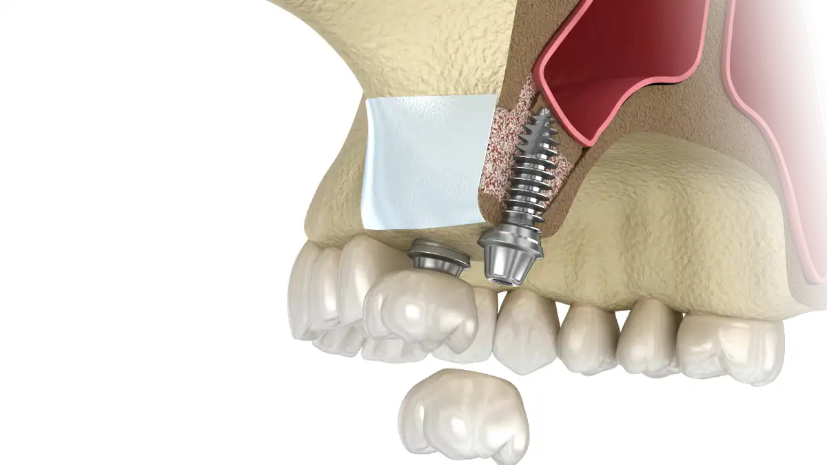 Confecção dos provisórios junto dos implantes ou após 6 meses