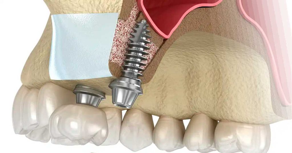 Implante Dentário 7 Imagem ilustrativa do levantamento de seio maxilar com implantes dentários