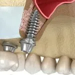 Implante Dentário 13 Imagem ilustrativa do levantamento de seio maxilar com implantes dentários