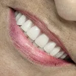Implante Dentário 10 Sorriso da Maria Helena que usa protocolo superior e inferior em carga imediata.