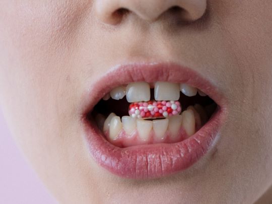 Planejamento para cirurgia de fechamento de diastema na Clínica Muglia, mostrando detalhe de paciente com espaço entre os dentes e cápsula colorida.