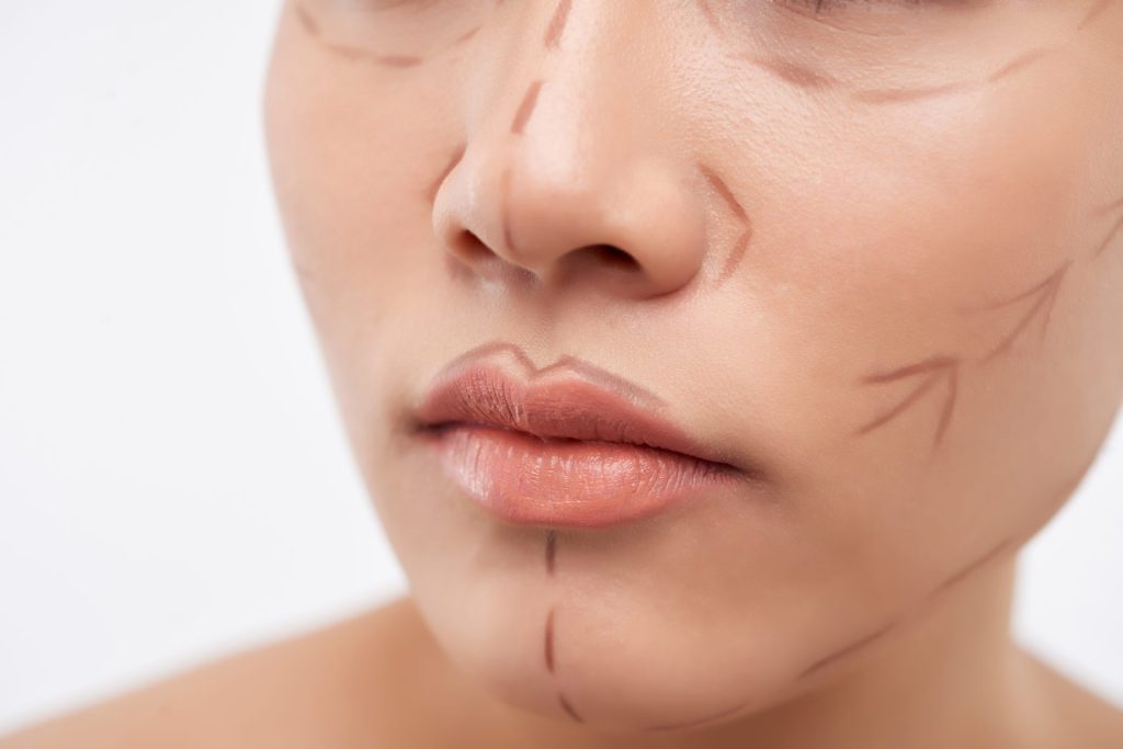 Detalhe de rosto com marcações para procedimento de lifting facial para rejuvenescimento.