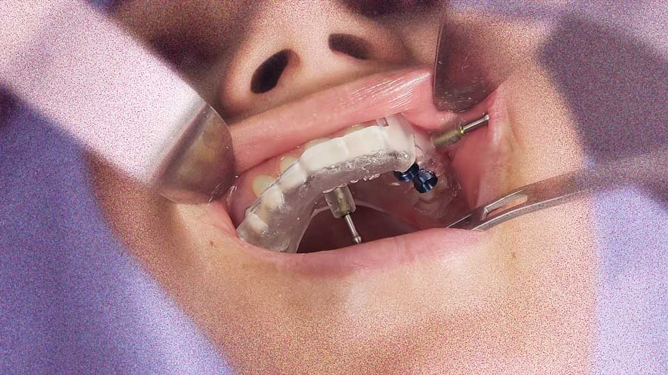 Implante Dentário 5 Guia cirurgica prototipado em posição para transportar o planejamento virtual para a situação real: Implante Guiado