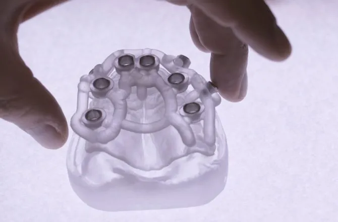 Implante Guiado: Precisão e Tecnologia para o Seu Sorriso na Clínica Muglia