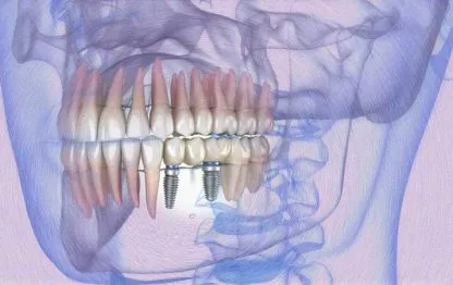 Carga Imediata em Dentes Posteriores: É possível?