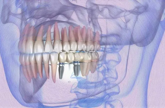 Carga Imediata em Dentes Posteriores: É possível?