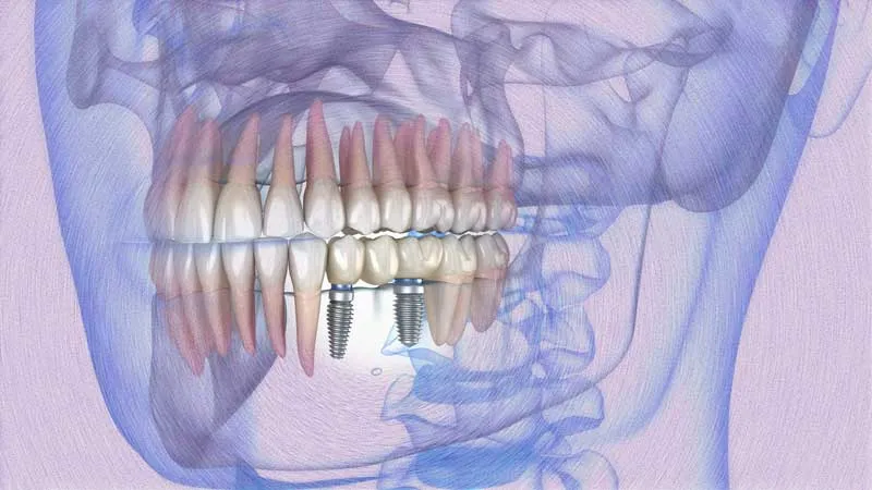 Modelo em 3d representando a Carga Imediata em Dentes Posteriores: uma ponte de 3 dentes sobre 2 implantes dentários entre primeiro pré e primeiro molar.