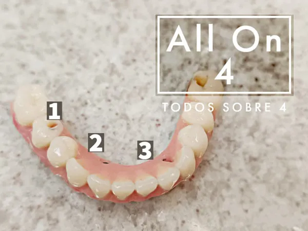 Implante Dentário 4 allonfour implantes vargem grande paulista.jpg