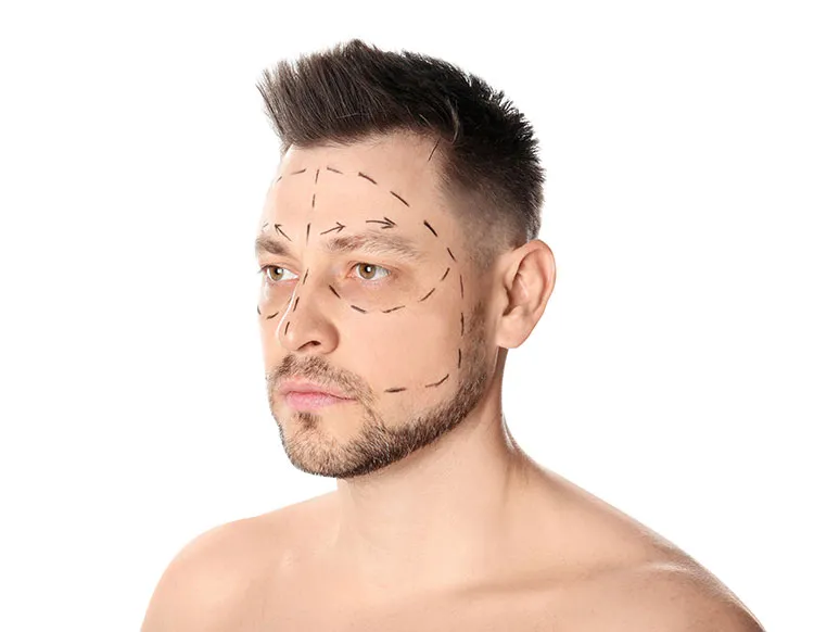 Rosto masculino com marcações cirúrgicas para planejamento de harmonização facial orofacial.