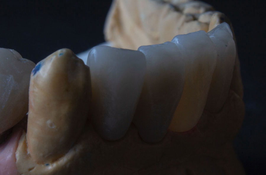 Ponte fixa parcial de 4 elementos em porcelana instalada sobre modelo odontológico, demonstrando a reabilitação de dentes ausentes com prótese fixa.