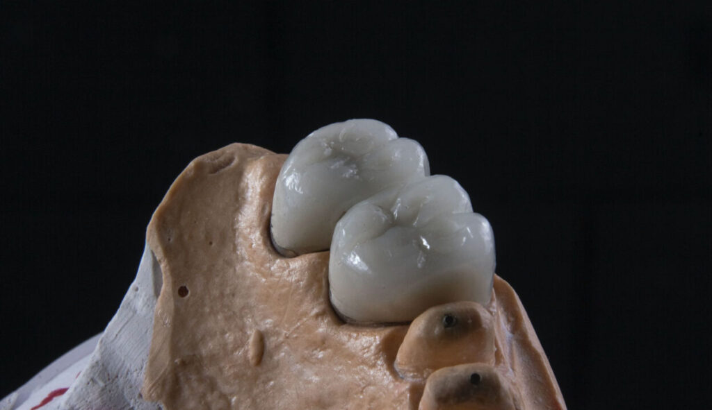Coroas de porcelana pura instaladas e preparos dentários do tipo núcleo em modelo odontológico de precisão.